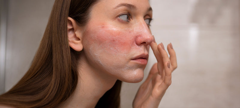 Let’s Talk About Rosacea