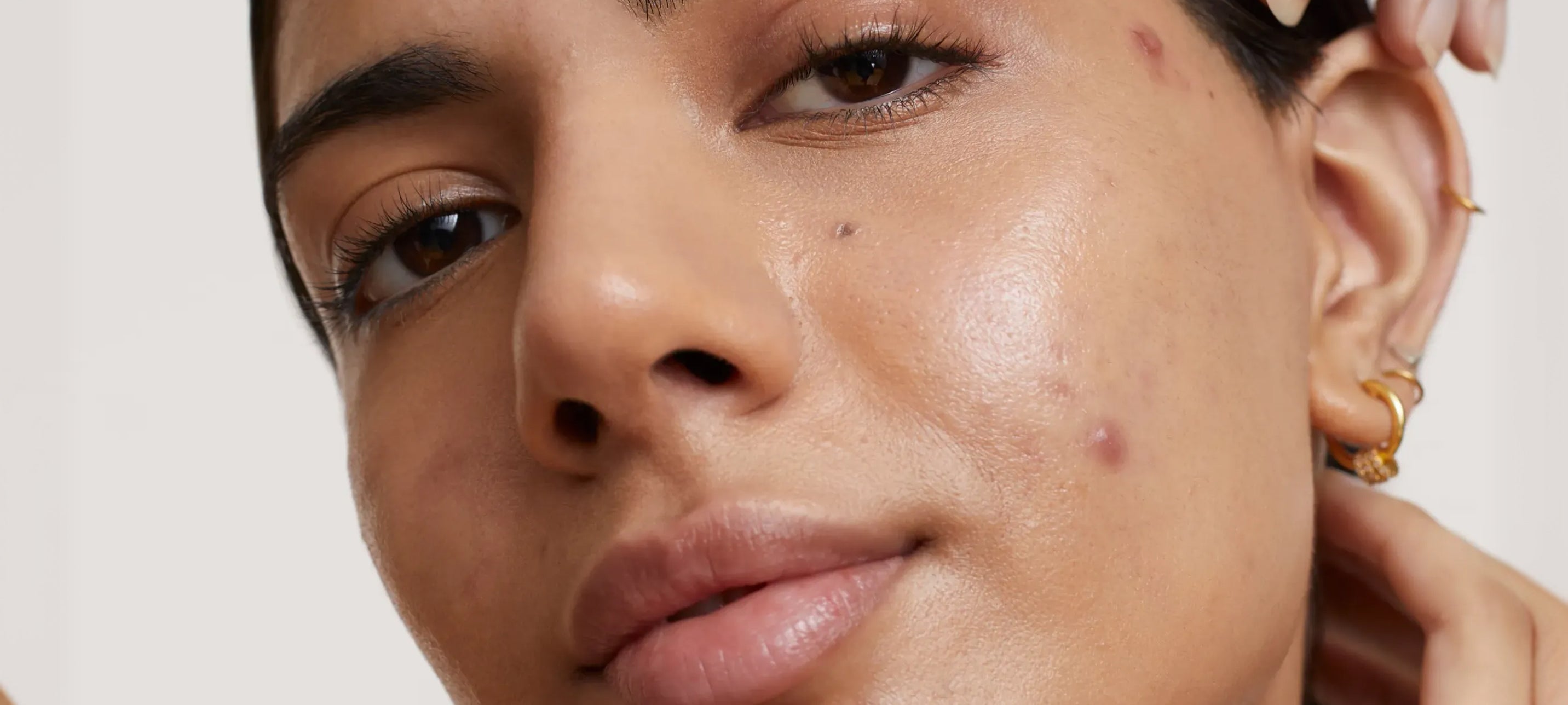 The Complete Guide to Acne: Myths, Mistakes and What Actually Works