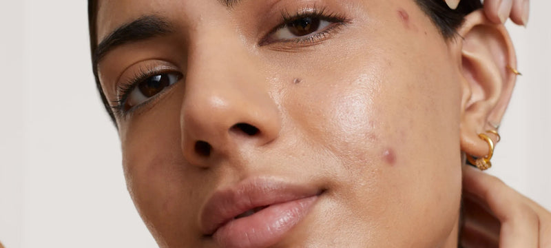 The Complete Guide to Acne: Myths, Mistakes and What Actually Works
